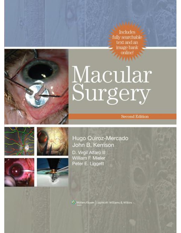 Macular Surgery